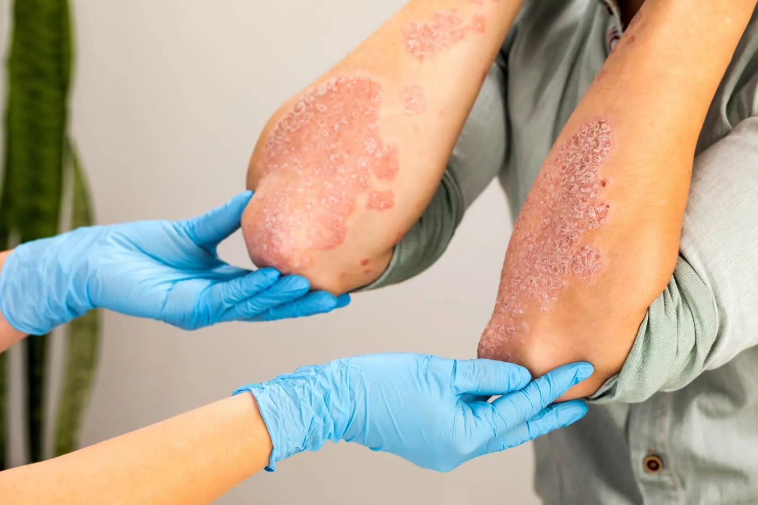 dermatologist-wearing-gloves-examines-skin-sick-eczema-dermatitis